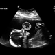 Illustration for article titled This Baby Had a Peach-Sized Tumor Removed With Lasers While in the Womb